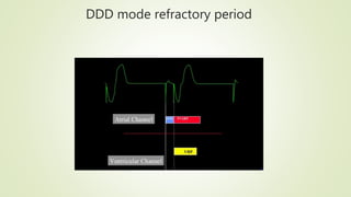 PM Dual chamber mode | PPTX