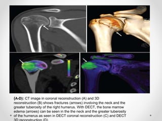 (A-D): CT image in coronal reconstruction (A) and 3D
reconstruction (B) shows fractures (arrows) involving the neck and the
greater tuberosity of the right humerus. With DECT, the bone marrow
edema (arrows) can be seen in the the neck and the greater tuberosity
of the humerus as seen in DECT coronal reconstruction (C) and DECT
 