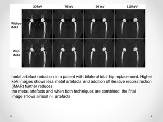 metal artefact reduction in a patient with bilateral total hip replacement. Higher
keV images shows less metal artefacts and addition of iterative reconstruction
(iMAR) further reduces
the metal artefacts and when both techniques are combined, the final
image shows almost nil artefacts
 
