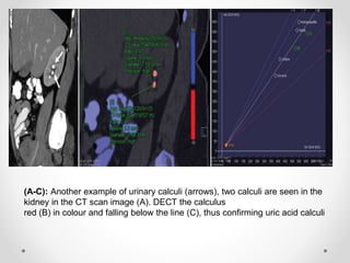 (A-C): Another example of urinary calculi (arrows), two calculi are seen in the
kidney in the CT scan image (A). DECT the calculus
red (B) in colour and falling below the line (C), thus confirming uric acid calculi
 