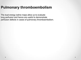 Pulmonary thromboembolism
The dual energy iodine maps allow us to evaluate
lung perfusion and hence are useful to demonstrate
perfusion defects in cases of pulmonary thromboembolism.
 