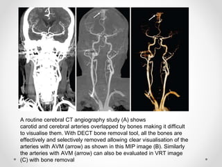 A routine cerebral CT angiography study (A) shows
carotid and cerebral arteries overlapped by bones making it difficult
to visualise them. With DECT bone removal tool, all the bones are
effectively and selectively removed allowing clear visualisation of the
arteries with AVM (arrow) as shown in this MIP image (B). Similarly
the arteries with AVM (arrow) can also be evaluated in VRT image
(C) with bone removal
 