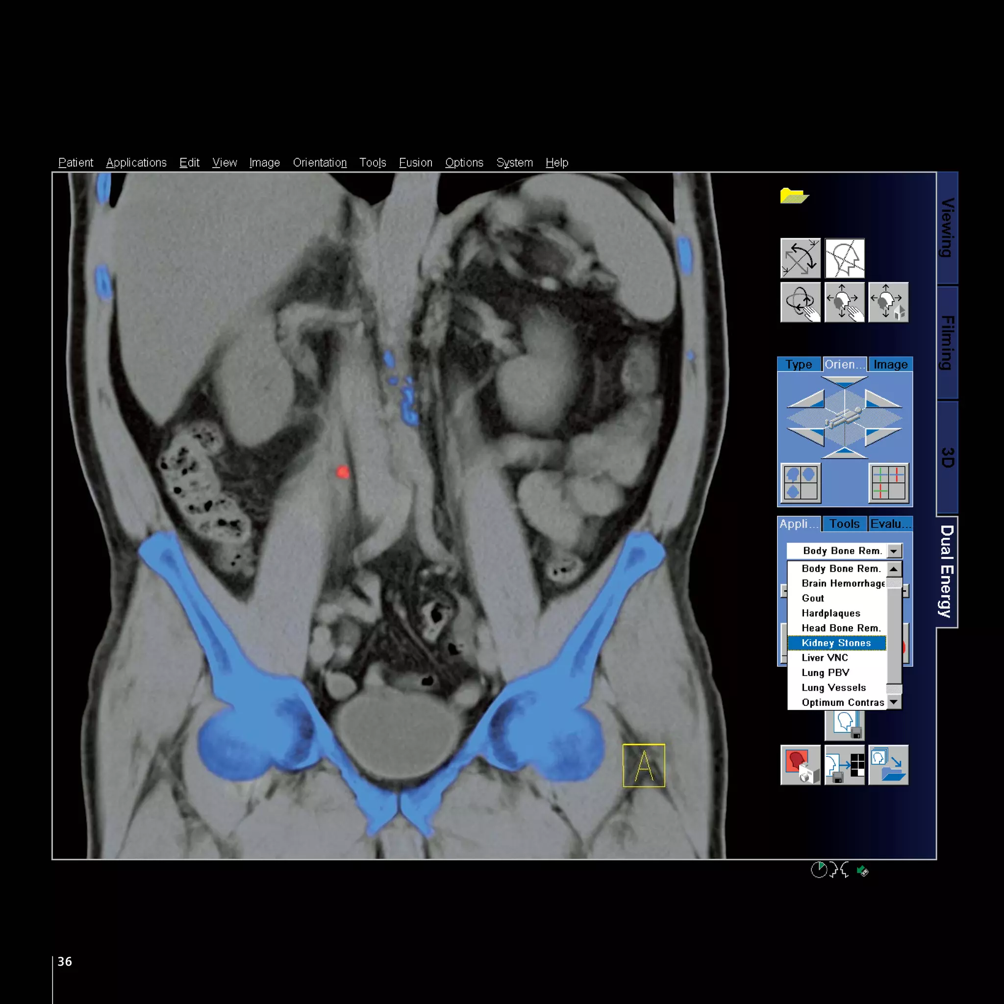Dual Energy CT - SIEMENS | PDF