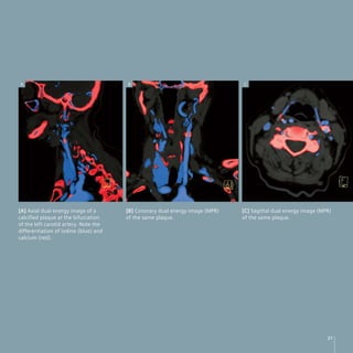A                                      B                                      C




[A] Axial dual energy image of a       [B] Coronary dual energy image (MPR)   [C] Sagittal dual energy image (MPR)
calcified plaque at the bifurcation    of the same plaque.                    of the same plaque.
of the left carotid artery. Note the
differentiation of iodine (blue) and
calcium (red).




                                                                                                                21
 