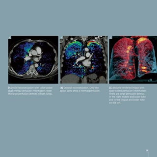 A                                            B                                       C




[A] Axial reconstruction with color-coded    [B] Coronal reconstruction. Only the    [C] Volume-rendered image with
dual energy perfusion information. Note      apical parts show a normal perfusion.   color-coded perfusion information.
the large perfusion defects in both lungs.                                           There are large perfusion defects
                                                                                     in the right middle and lower lobe
                                                                                     and in the lingual and lower lobe
                                                                                     on the left.




                                                                                                                      29
 