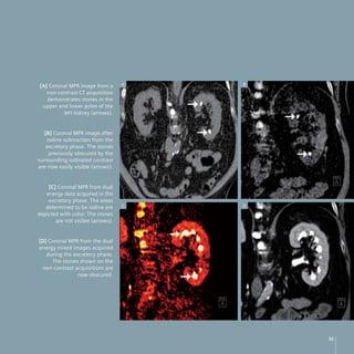 [A] Coronal MPR image from a       A   B
   non-contrast CT acquisition
   demonstrates stones in the
 upper and lower poles of the
         left kidney (arrows).


   [B] Coronal MPR image after
    iodine subtraction from the
    excretory phase. The stones
     previously obscured by the
surrounding iodinated contrast
are now easily visible (arrows).


    [C] Coronal MPR from dual
   energy data acquired in the
    excretory phase. The areas
   determined to be iodine are     C   D
depicted with color. The stones
       are not visible (arrows).


[D] Coronal MPR from the dual
energy mixed images acquired
   during the excretory phase.
     The stones shown on the
 non-contrast acquisitions are
                now obscured.




                                           35
 