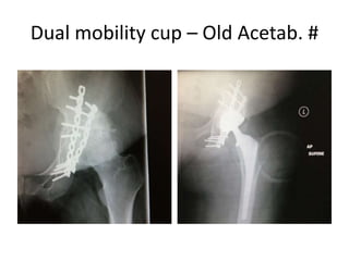 Dual mobility cup – Old Acetab. #
 