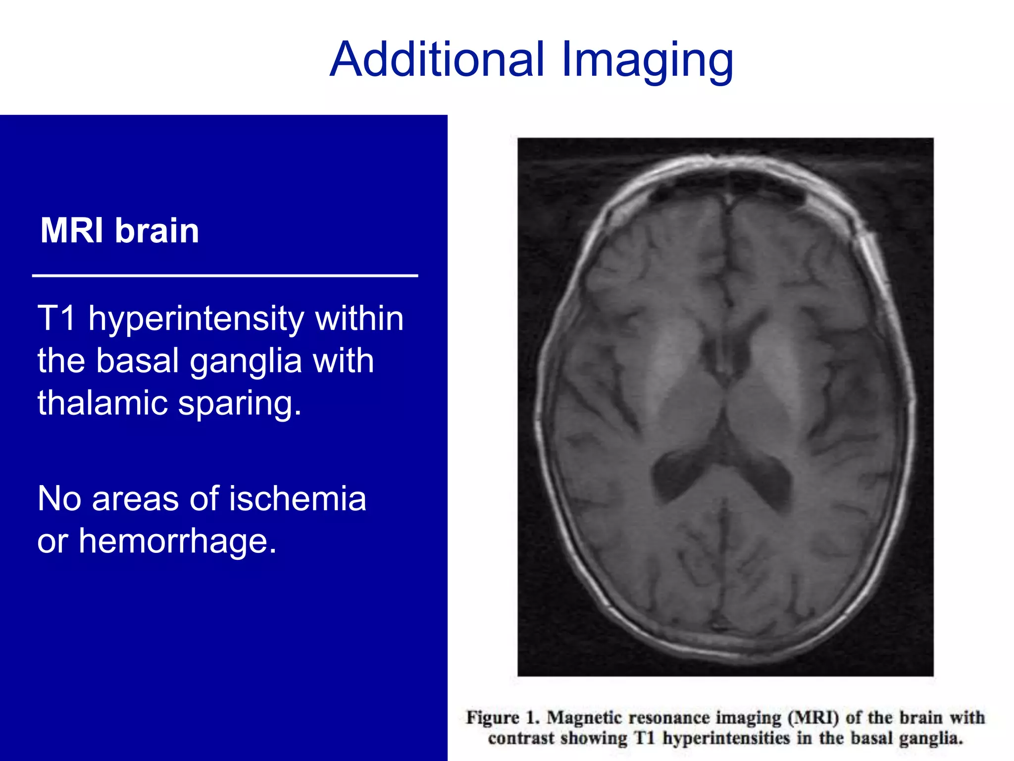 Additional Imaging
MRI brain
T1 hyperintensity within
the basal ganglia with
thalamic sparing.
No areas of ischemia
or hemorrhage.
 