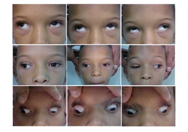 duane retraction syndrome