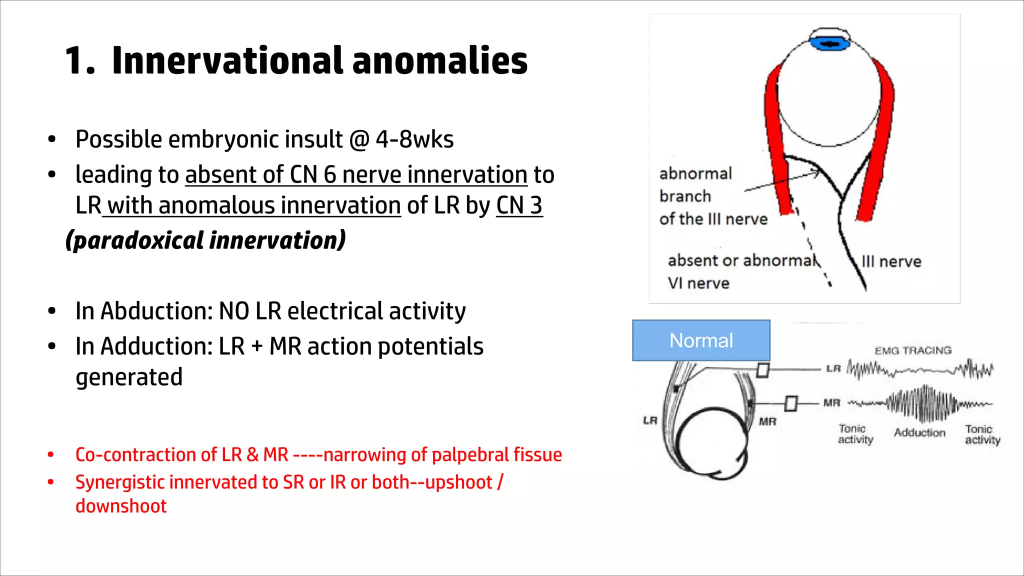1. Innervational anomalies
• Possible embryonic insult @ 4-8wks
• leading to absent of CN 6 nerve innervation to
LR with anomalous innervation of LR by CN 3
(paradoxical innervation)
• In Abduction: NO LR electrical activity
• In Adduction: LR + MR action potentials
generated
• Co-contraction of LR & MR ----narrowing of palpebral fissue
• Synergistic innervated to SR or IR or both--upshoot /
downshoot
Normal
 