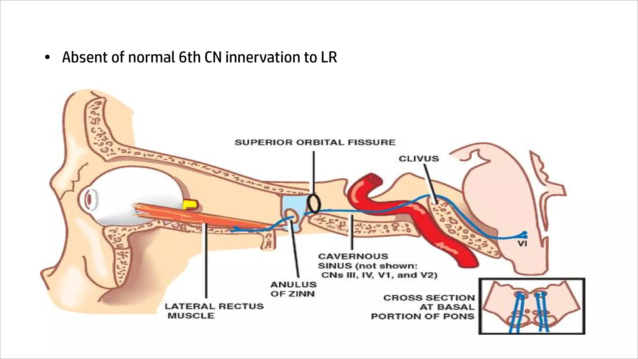 • Absent of normal 6th CN innervation to LR
Supportive evidence (Synkinesis)
• Marcus Gunn Jaw Winking phenomenon
• Crocodile tears
Lesion Example
Supranuclear Brainstem abnormality
Nuclear 6th nucleus hypoplasia / complete absent
Infranuclear anamalous innervation by 3rd CN
 