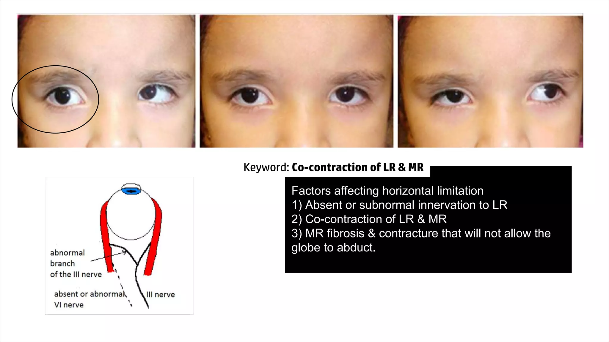 Factors affecting horizontal limitation
1) Absent or subnormal innervation to LR
2) Co-contraction of LR & MR
3) MR fibrosis & contracture that will not allow the
globe to abduct.
Keyword: Co-contraction of LR & MR
 