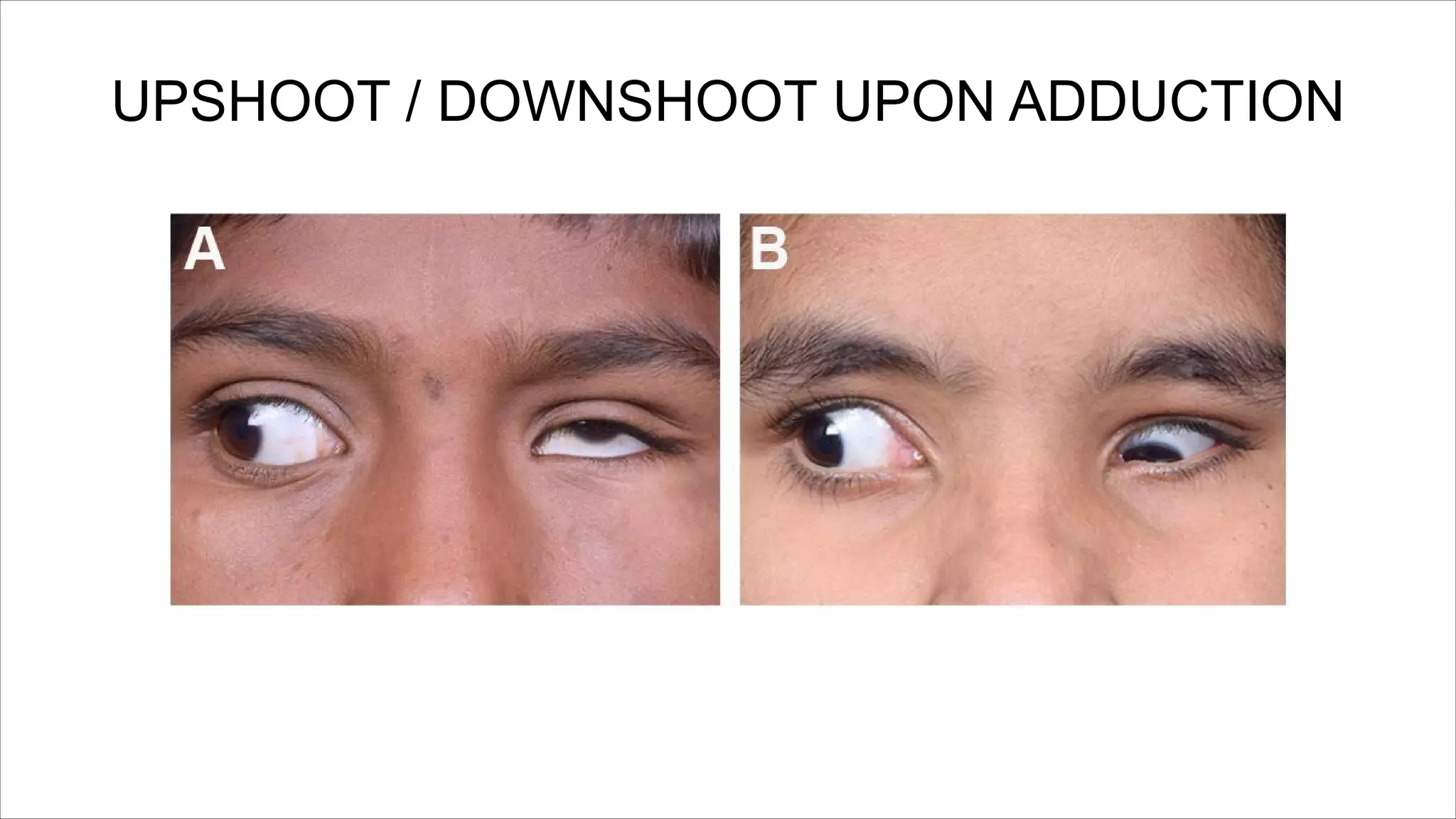 UPSHOOT / DOWNSHOOT UPON ADDUCTION
 