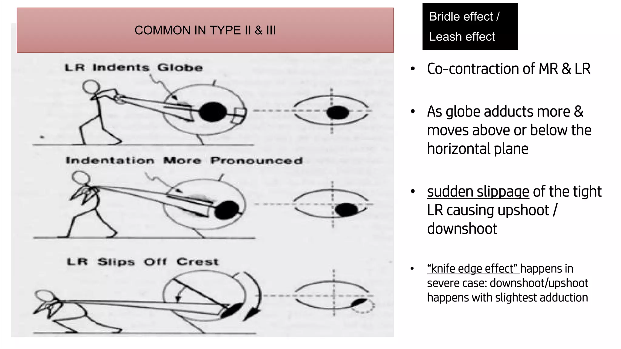 • Co-contraction of MR & LR
• As globe adducts more &
moves above or below the
horizontal plane
• sudden slippage of the tight
LR causing upshoot /
downshoot
• “knife edge effect” happens in
severe case: downshoot/upshoot
happens with slightest adduction
Bridle effect /
Leash effect
COMMON IN TYPE II & III
 
