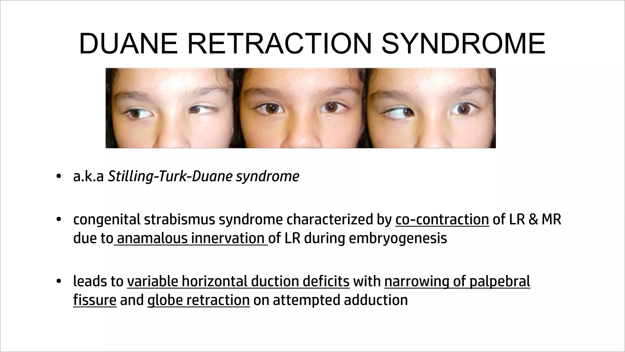 DUANE RETRACTION SYNDROME
• a.k.a Stilling-Turk-Duane syndrome
• congenital strabismus syndrome characterized by co-contraction of LR & MR
due to anamalous innervation of LR during embryogenesis
• leads to variable horizontal duction deficits with narrowing of palpebral
fissure and globe retraction on attempted adduction
 