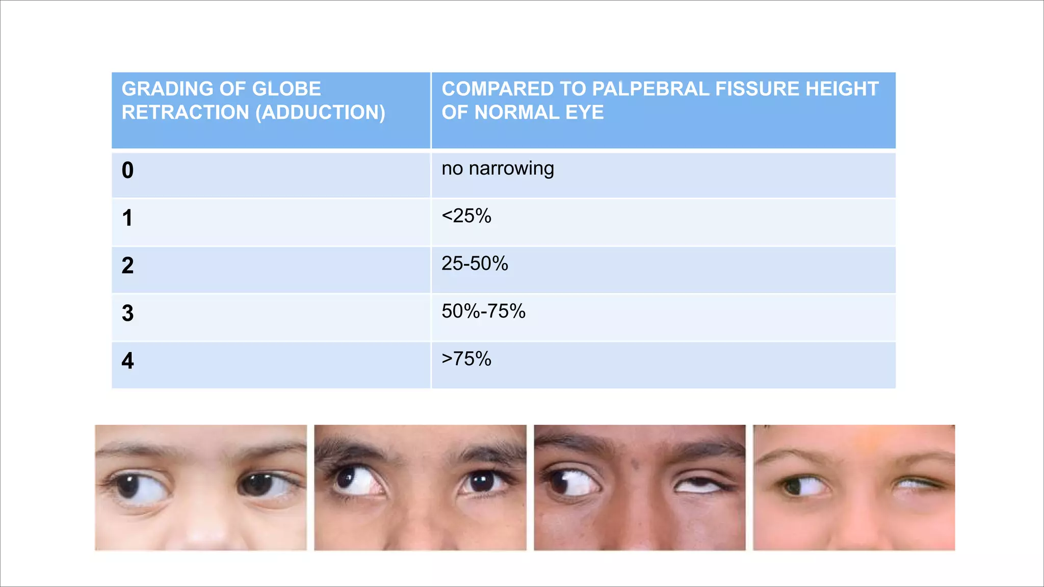 GRADING OF GLOBE
RETRACTION (ADDUCTION)
COMPARED TO PALPEBRAL FISSURE HEIGHT
OF NORMAL EYE
0 no narrowing
1 <25%
2 25-50%
3 50%-75%
4 >75%
 