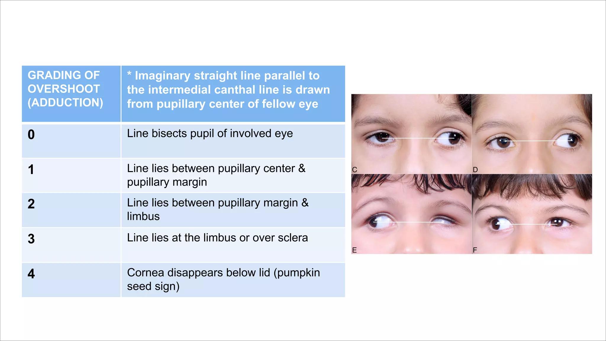 GRADING OF
OVERSHOOT
(ADDUCTION)
* Imaginary straight line parallel to
the intermedial canthal line is drawn
from pupillary center of fellow eye
0 Line bisects pupil of involved eye
1 Line lies between pupillary center &
pupillary margin
2 Line lies between pupillary margin &
limbus
3 Line lies at the limbus or over sclera
4 Cornea disappears below lid (pumpkin
seed sign)
 