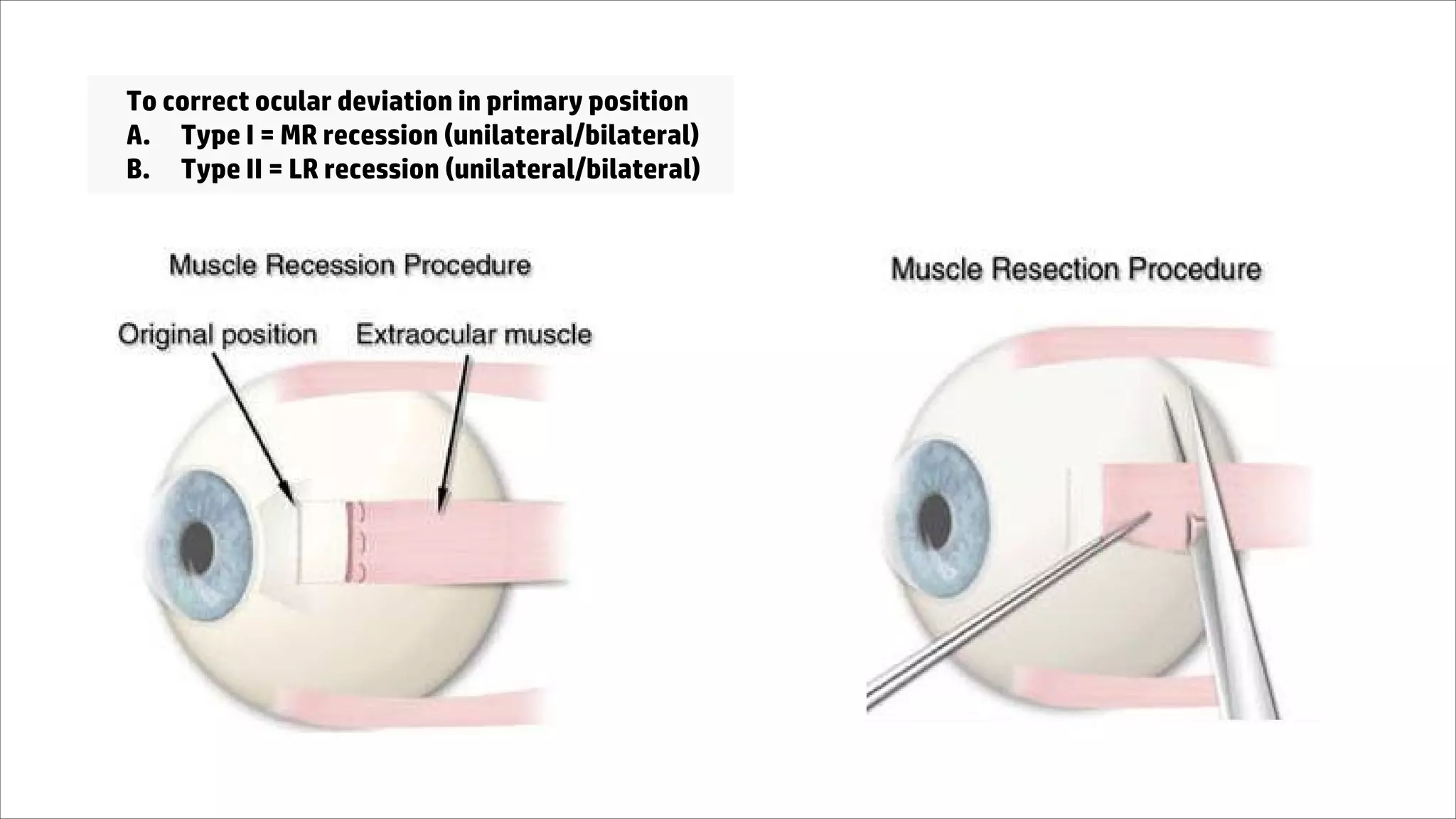 To correct ocular deviation in primary position
A. Type I = MR recession (unilateral/bilateral)
B. Type II = LR recession (unilateral/bilateral)
 