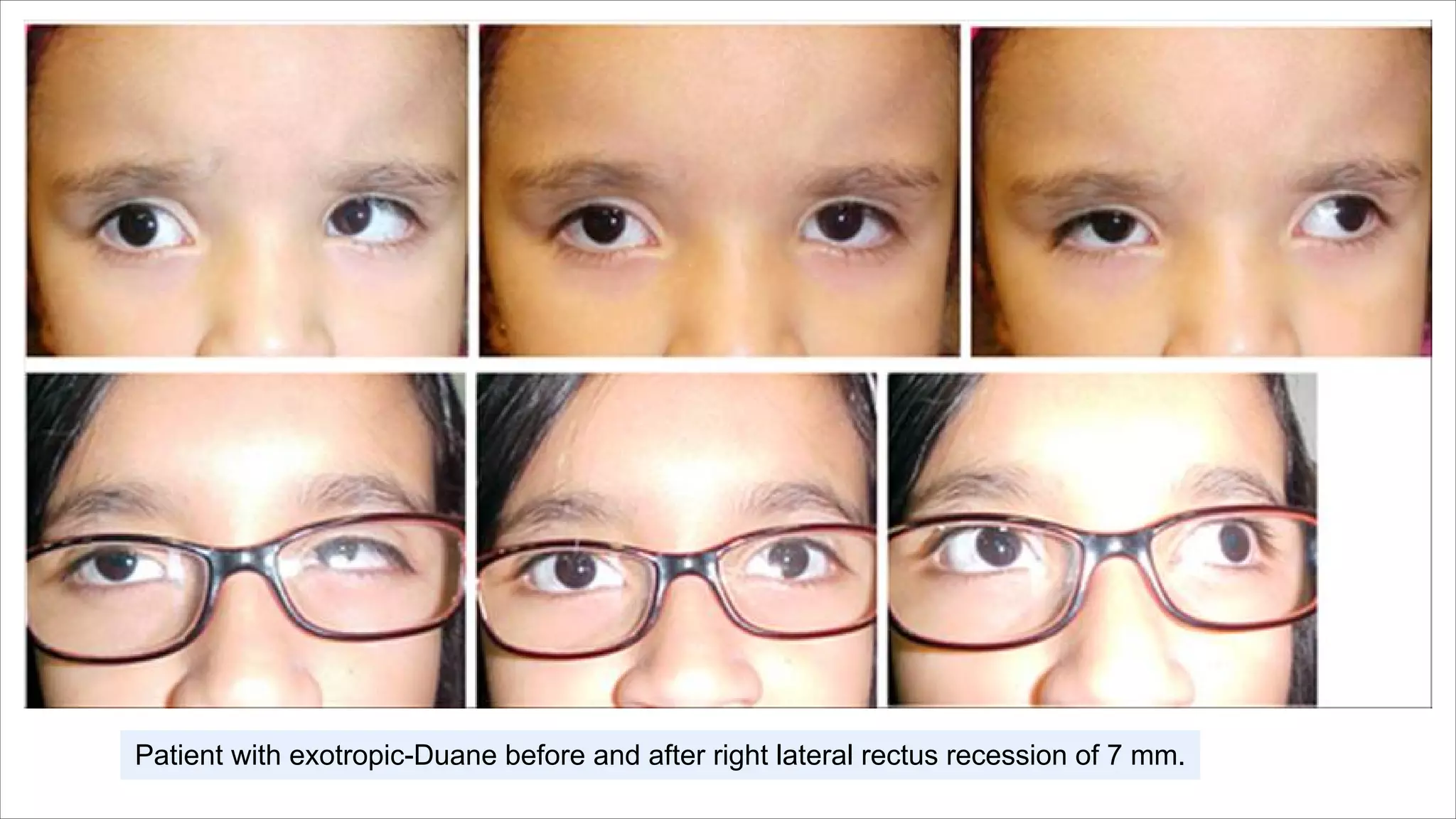 Patient with exotropic-Duane before and after right lateral rectus recession of 7 mm.
 