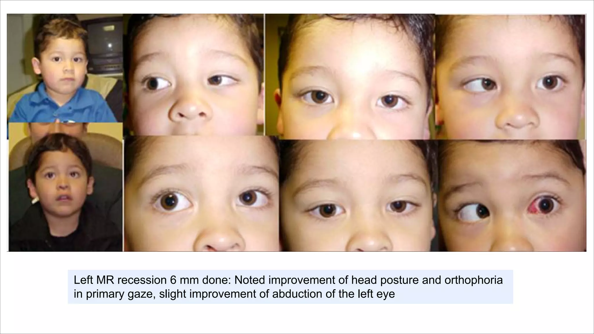 Left MR recession 6 mm done: Noted improvement of head posture and orthophoria
in primary gaze, slight improvement of abduction of the left eye
 