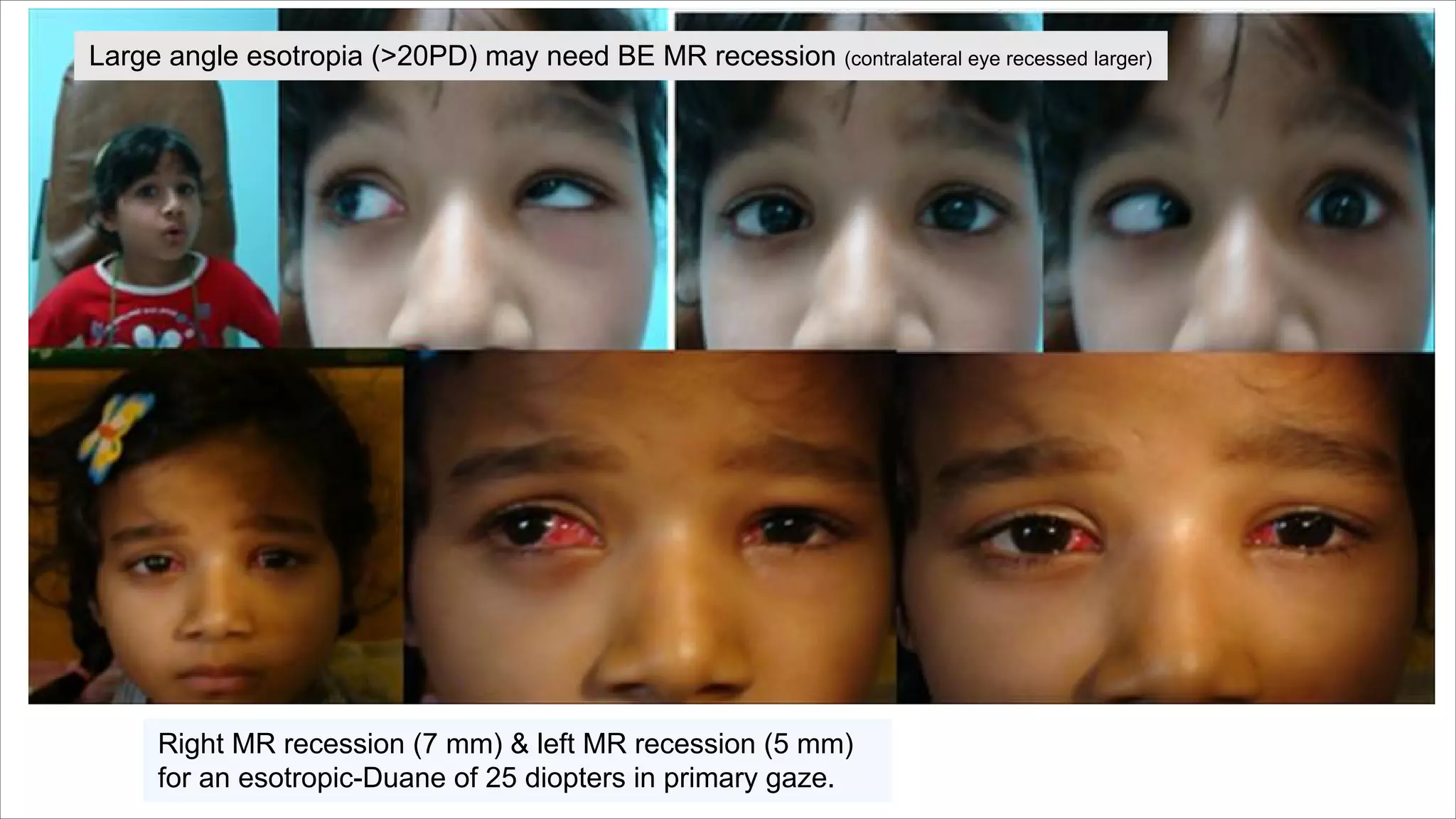 Right MR recession (7 mm) & left MR recession (5 mm)
for an esotropic-Duane of 25 diopters in primary gaze.
Large angle esotropia (>20PD) may need BE MR recession (contralateral eye recessed larger)
 