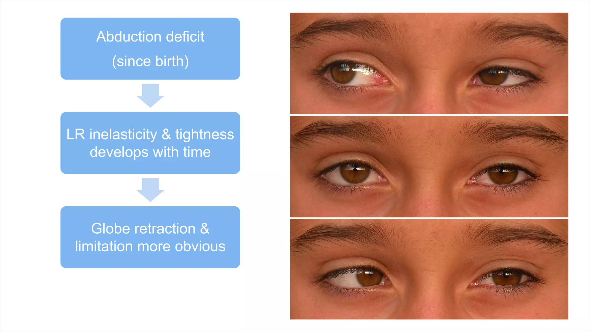 Abduction deficit
(since birth)
LR inelasticity & tightness
develops with time
Globe retraction &
limitation more obvious
 