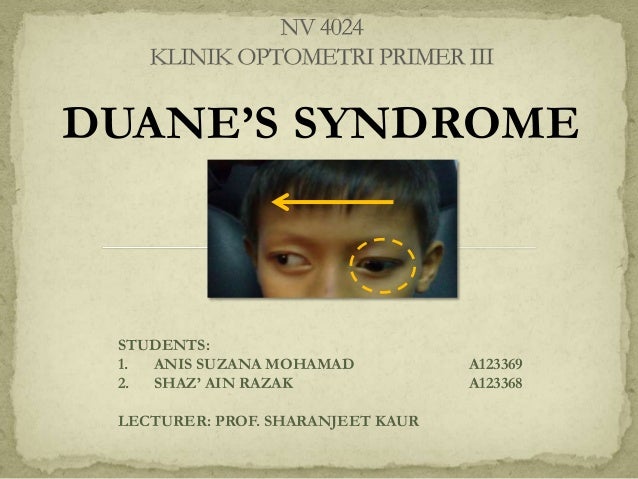 case presentation duane s syndrome
