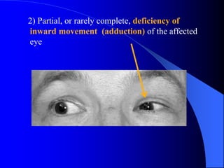 2) Partial, or rarely complete, deficiency of
inward movement (adduction) of the affected
eye
 