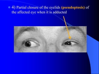  4) Partial closure of the eyelids (pseudoptosis) of
the affected eye when it is adducted
 