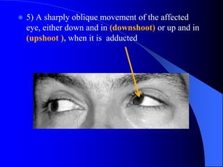  5) A sharply oblique movement of the affected
eye, either down and in (downshoot) or up and in
(upshoot ), when it is adducted
 