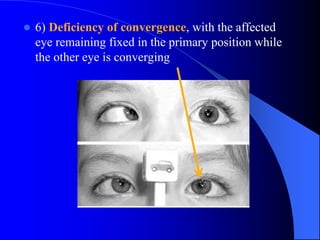  6) Deficiency of convergence, with the affected
eye remaining fixed in the primary position while
the other eye is converging
 