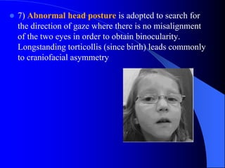  7) Abnormal head posture is adopted to search for
the direction of gaze where there is no misalignment
of the two eyes in order to obtain binocularity.
Longstanding torticollis (since birth) leads commonly
to craniofacial asymmetry
 