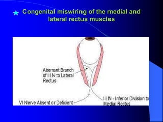Congenital miswiring of the medial and
lateral rectus muscles
 
