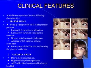CLINICAL FEATURES
 A left Brown syndrome has the following
characteristics:
 1 MAJOR SIGNS
 • Usually straight with BSV in the primary
position
• Limited left elevation in adduction
• Limited left elevation on upgaze is
common
• Normal left elevation in abduction
• Absence of left superior oblique
overaction
• Positive forced duction test on elevating
the globe in adduction.
2 VARIABLE SIGNS
 • Down-shoot in adduction.
• Hypotropia in primary position.
• AHP with chin elevation and ipsilateral
head tilt
 