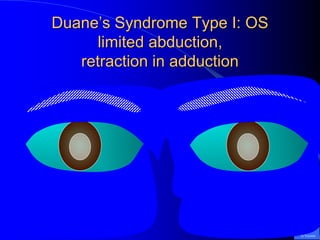 Duane’s Syndrome Type I: OS
limited abduction,
retraction in adduction
G.Vicente
 