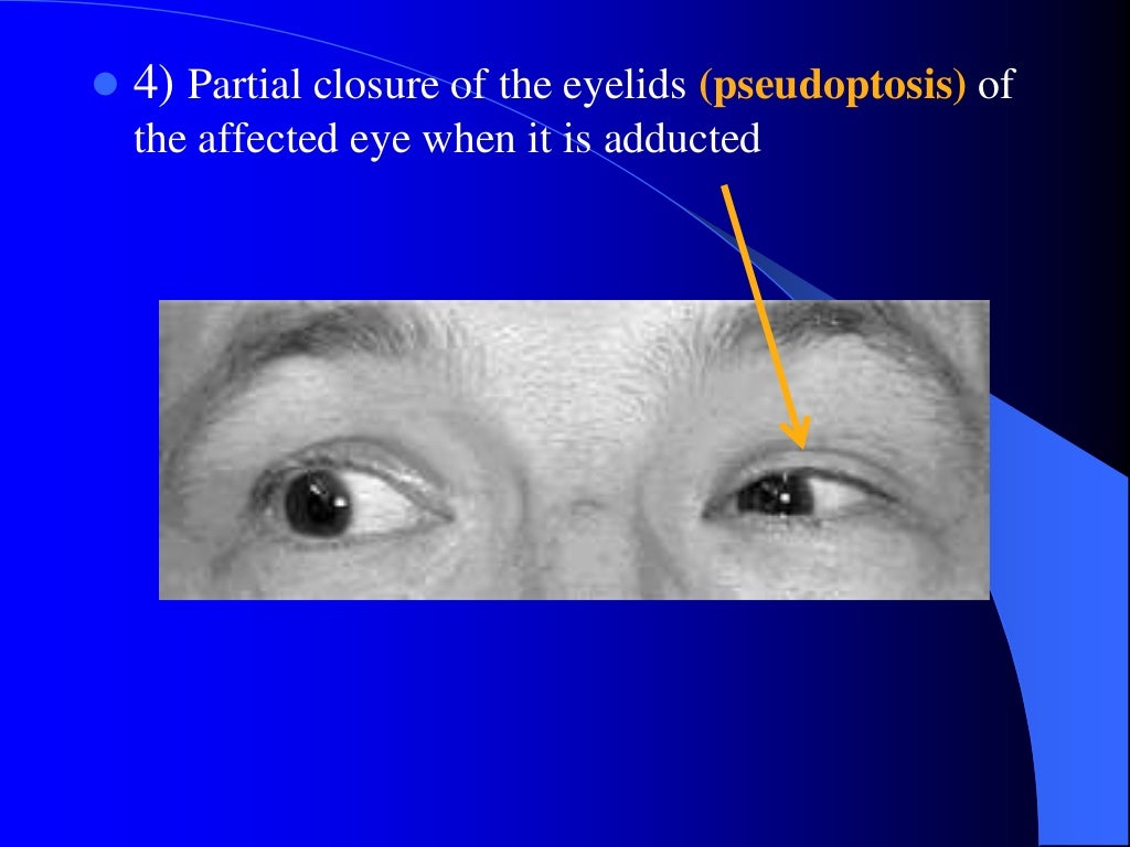 Duanes retraction syndrome