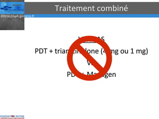 Traitement combiné VERITAS PDT + triamcinolone (4 mg ou 1 mg) Vs. PDT + Macugen 