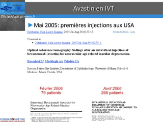Avastin en IVT Mai 2005: premières injections aux USA Février 2006 79 patients Avril 2006 266 patients 