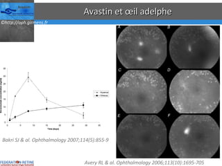 Avastin et œil adelphe Bakri SJ & al. Ophthalmology 2007;114(5):855-9 Avery RL & al. Ophthalmology 2006;113(10):1695-705 