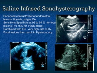 Enhanced contrast/relief of endometrial lesions: fibroids, polyps CA Sensitivity/Specificity at 93 to 94 %  for focal lesions ( vs 75% for TVUS alone) Combined with EB:  very high rate of Dx Focal lesions then result in Hysteroscopy 