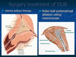 Surgery treatment of DUB Uterine balloon therapy Roller-ball endometriaal ablation usting resectoscope 