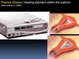 Therma Choice: Heating element within the balloon
(Neuwirth et al 1994)
Aboubakr Elnashar
 