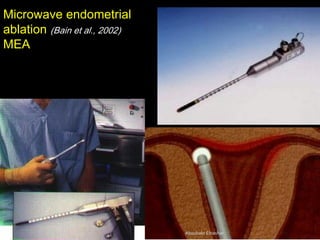 Microwave endometrial
ablation (Bain et al., 2002)
MEA
Aboubakr Elnashar
 