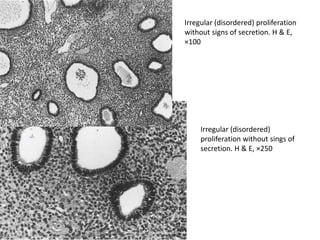 Irregular (disordered) proliferation
without signs of secretion. H & E,
×100
Irregular (disordered)
proliferation without sings of
secretion. H & E, ×250
 