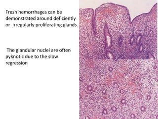 Fresh hemorrhages can be
demonstrated around deficiently
or irregularly proliferating glands.
The glandular nuclei are often
pyknotic due to the slow
regression
 