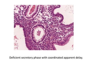Deficient secretory phase with coordinated apparent delay.
 