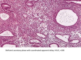 Deficient secretory phase with coordinated apparent delay. H & E, ×100
 