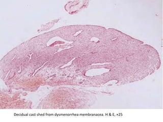 Decidual cast shed from dysmenorrhea membranacea. H & E, ×25
 
