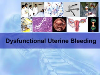 Dysfunctional Uterine Bleeding
 