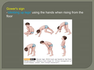 Gower's sign
-'climbing up legs' using the hands when rising from the
floor

 